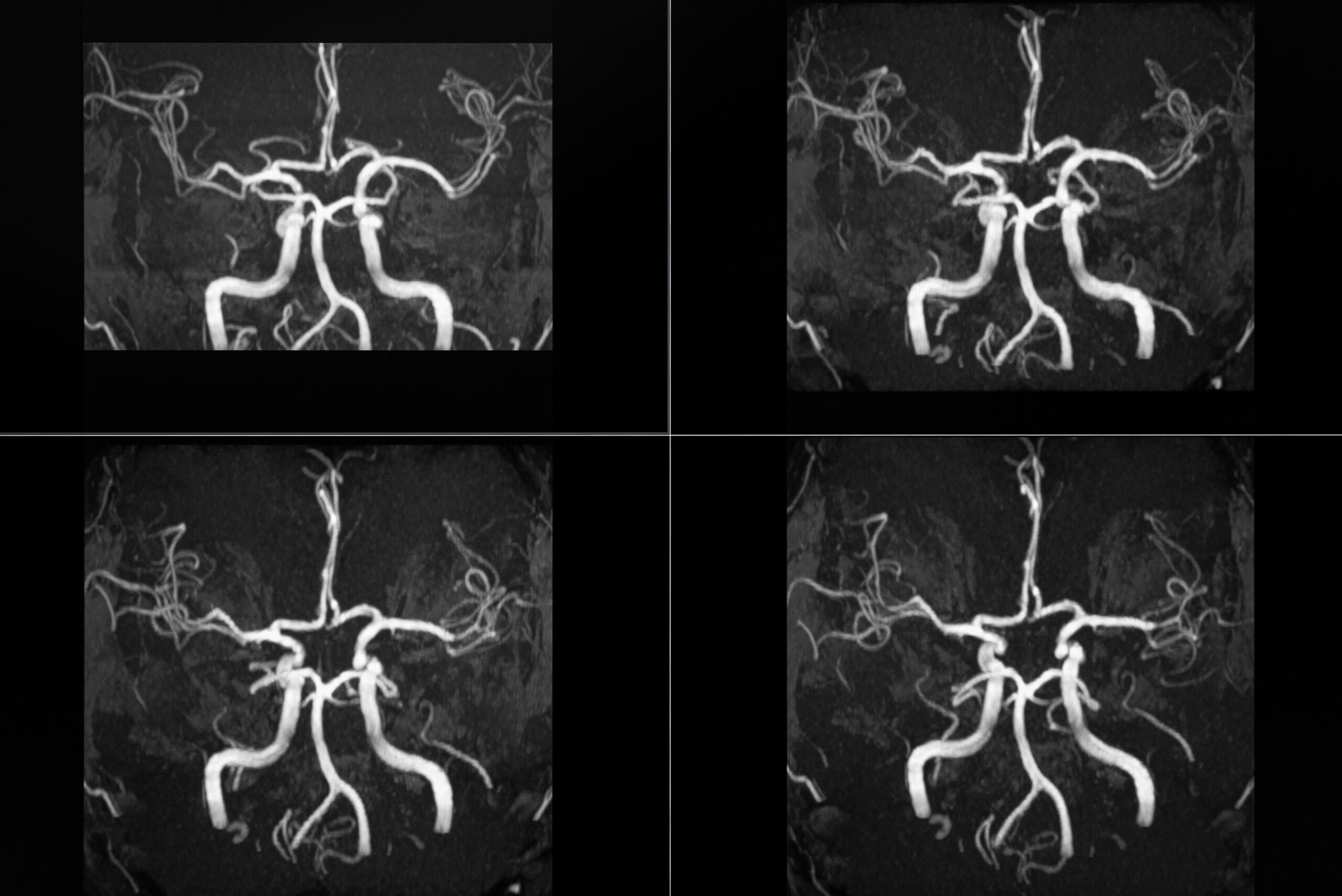 MRT images of the human head vessels