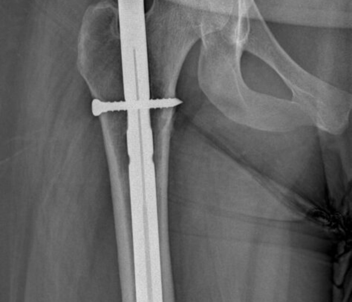 X-ray Image of Femur Fracture with IM Nail