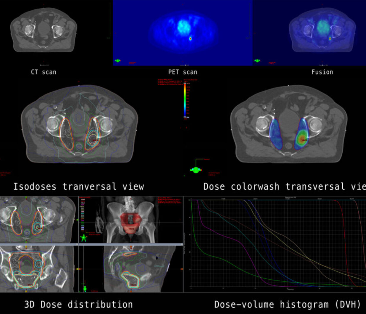 The overview shows CT and PET cross-sections of a patient with a malignant neoplasm of the prostate and pelvic lymph node involvement. Furthermore, the result of the calculation for radiation therapy.